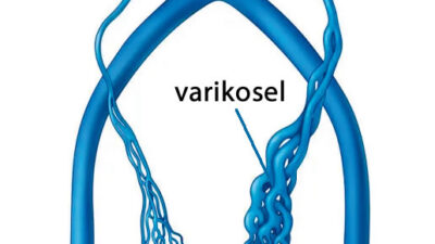 Varikosel, genellikle testislerdeki damarlarda oluşan genişlemelerdir ve erkeklerde yaygın bir