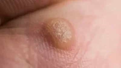 Çoğu siğil zararsızdır ve tedavi edilmeden haftalar ya da aylar