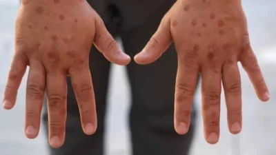 Son dönemde dünya genelinde yayılan maymun çiçeği virüsü (monkeypox) hakkında