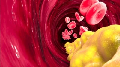 Kardiyoloji Uzmanı Dr. Murat Şener, kandaki yağların artmasıyla ilgili açıklamalarda