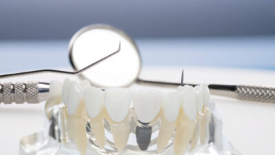   Diş kayıpları, hem estetik görünüm hem de çiğneme ve