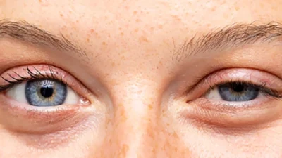 Çocuklarda göz kapaklarının düşmesi endişe kaynağı olabilir ve altta yatan