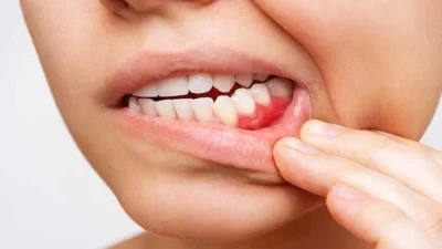 Diş eti çekilmesinin diş köklerinin açığa çıkması durumu olduğunu belirten