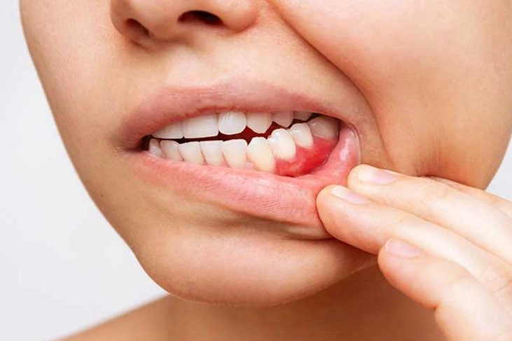 Diş eti çekilmesinin diş köklerinin açığa çıkması durumu olduğunu belirten